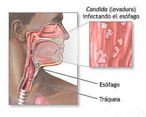 candidiasis-intestinal